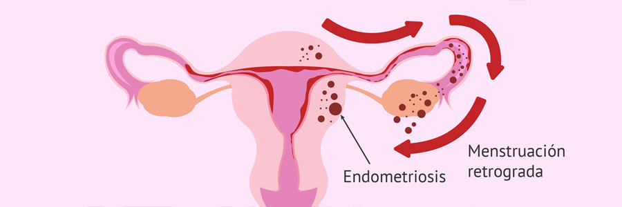 Menstruación Retrógrada